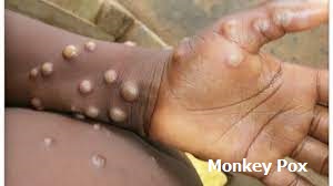 Monkeypox needs a better vaccine.